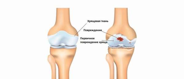 Остеоартроз сустава колена